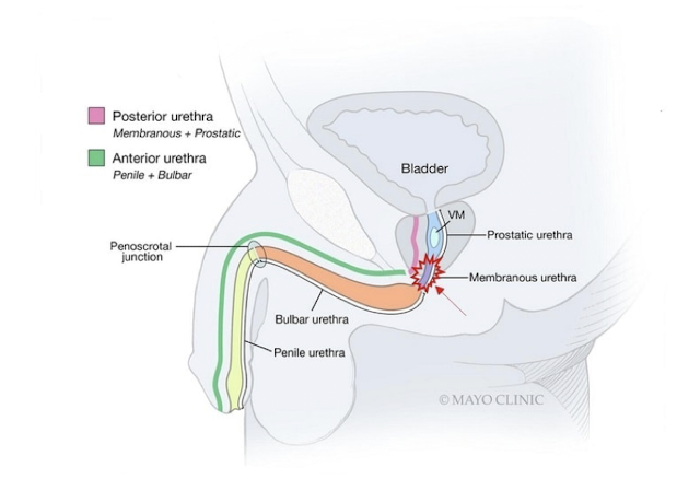 <p><strong>Abnormal tissue that narrows the lumen of the urethra</strong>, may be limited to mucosa or involve deep tissue layers, can be singular or multifocal<br>- typically affecting <strong>AMAB</strong>; <strong>idiopathic</strong>, iatrogenic, inflammatory causes<br>- anything inserted into the urethra (rigid camera, rigid catheterization) radiation therapy, STIs</p><p>S/S:<br>- Acute/chronic weak urine stream<br>- Have to push or strain to maintain urine stream<br>-<strong> Urine "sprays/splits"</strong><br>± acute urinary retention, recurrent UTIs</p>