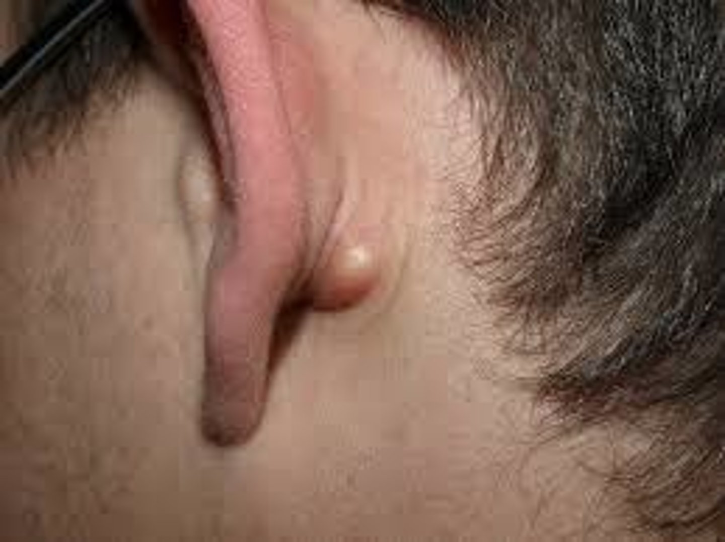 <p>thick-walled sac containing fluid (sebaceous cyst)</p>