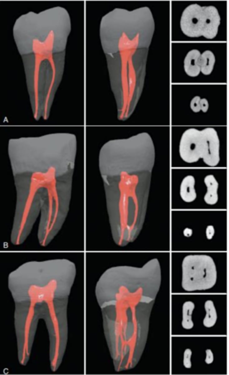 <p>mandibular 3rd molar</p>