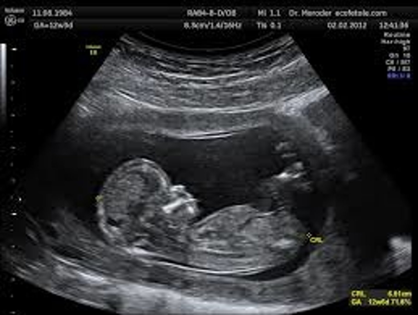 <p>the use of ultrasonic waves to see inside the body without performing surgery. This is used to see babies inside the womb as well as internal organs.</p>