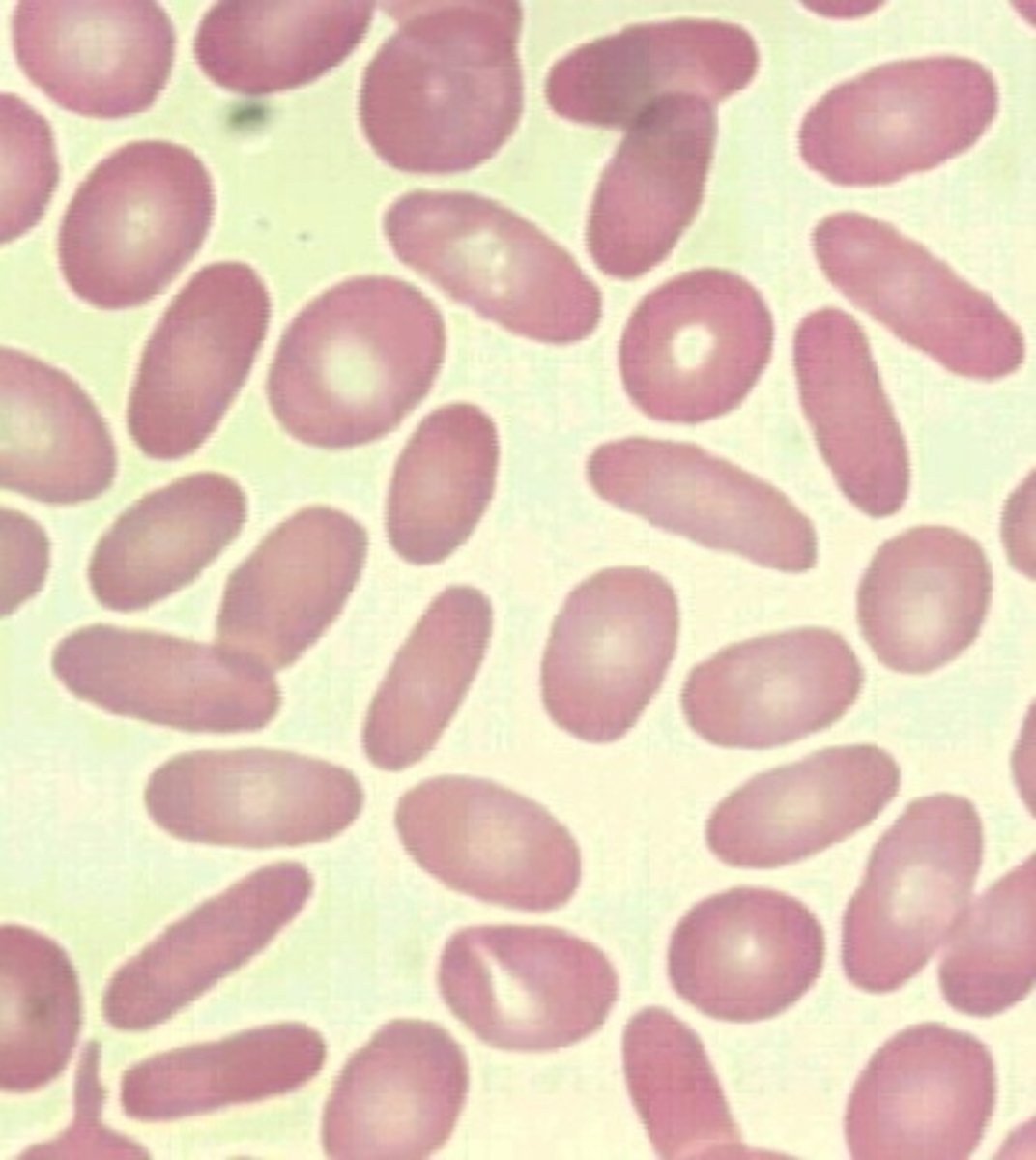 <p>Iron deficency anaemia</p>