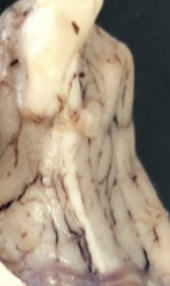 <p>olfactory tract (olfactory nerves go into olfactory foramina on ethmoid)</p>