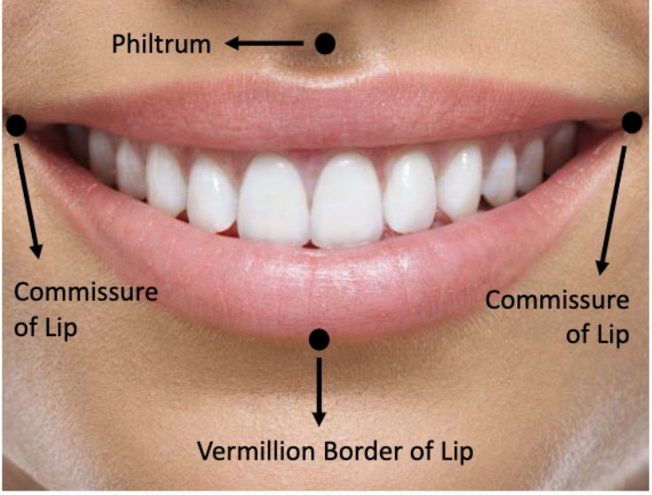 <p>commissure of lips</p>