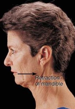 <p>Retraction</p>