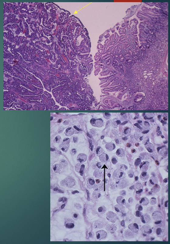 <ul><li><p>Carcinoma</p><ul><li><p>From surface epithelial cells</p></li><li><p>Associated with</p><ul><li><p>Intestinal metaplasia</p></li></ul></li></ul></li><li><p>Adenocarcinoma</p><ul><li><p>From glandular epithelium</p></li></ul></li><li><p>Stages</p><ul><li><p>Early</p><ul><li><p>Penetrate into submucosa</p></li><li><p>Good prognosis</p></li></ul></li><li><p>Late: poor prognosis</p><ul><li><p>Penetrate into muscularis externa</p></li></ul></li></ul></li></ul>