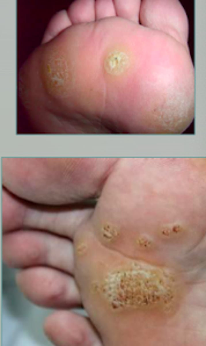 <p>Viral Skin Infections:</p><p><strong>plantar wart</strong></p><p>- skin-colored verrucous papules</p><p>- marked tenderness to palpation</p><p>- found on plantar surface of feet usually</p><p>- tend to coalesce</p><p>hard to treat</p>