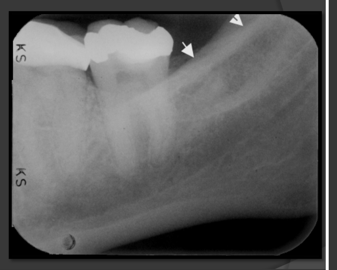 <p>Always the highest opaque line of the mandible that follows the contour of the jaw.</p>