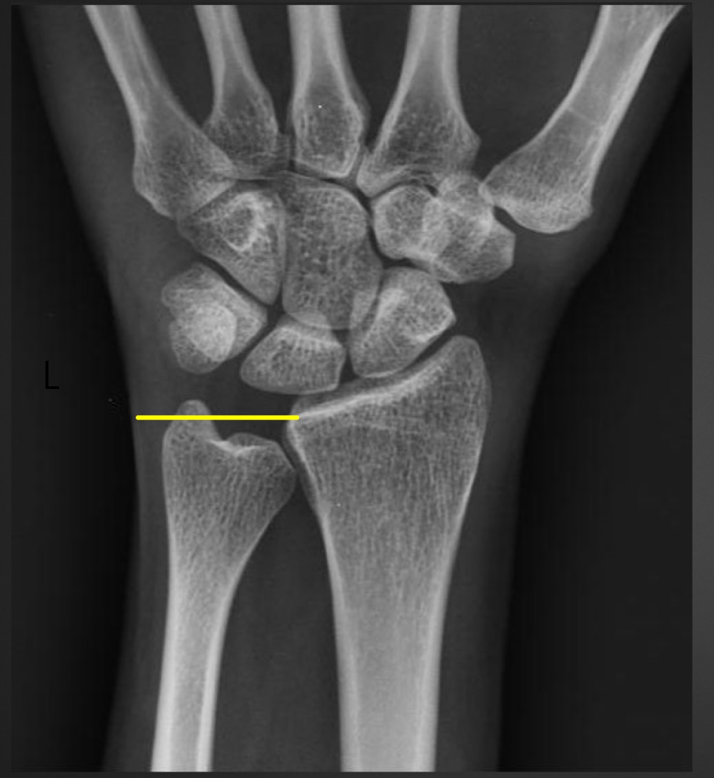 <p>what is a short ulna called and what are the ramifications </p>