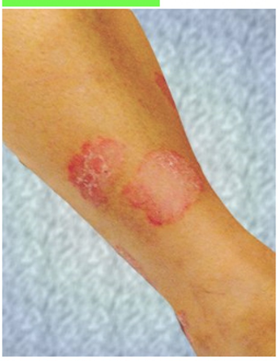 <p>Rationale</p><p>1. Melanoma typically is characterized by a colored, irregularly shaped lesion that can be mottled with light brown to black colors (p. 435).</p><p>2. The rashes associated with Lyme disease typically start as a red spot that expands with clearing of redness in the central area (p. 359).</p><p>3. Skin changes associated with scleroderma mainly include Raynaud phenomenon and tightening of the skin. Appearance of a rash is not typical of this disease. (pp. 445-447)</p><p>4. The image shows well-defined, dry, erythematous keratinous plaques, which are typical of psoriasis. These plaques are most commonly found in the scalp, extensor surfaces of extremities, and, in severe cases, the trunk. Identifying these plaques is important for the physical therapist in making decisions regarding referral for further medical attention. (pp. 440-441)</p>