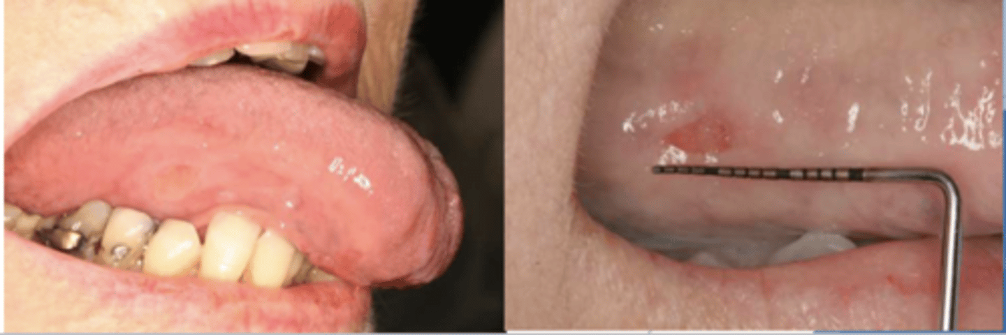 <p>what causes traumatic ulcers?</p>