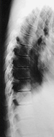 <p>What is this x-ray demonstrating?</p>