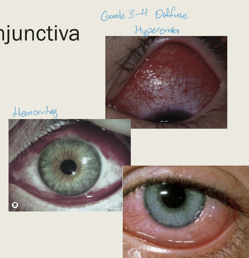 <ul><li><p>Hyperemia/injection: redness of the conjunctiva&nbsp;</p></li><li><p>Hemorrhage: area of bleeding seen with viral and occasionally bacterial conjunctivitis&nbsp;</p></li><li><p>Chemosis: area of conj swelling: acute represents hypersensitivity while chronic is associated with orbital outflow constriction&nbsp;</p></li></ul><p></p>