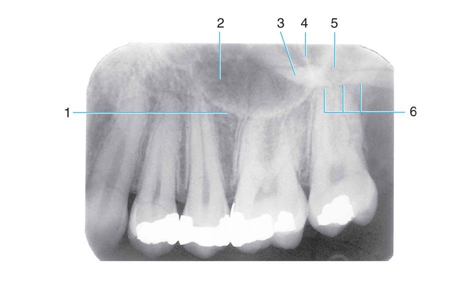 <p>Which number is the <strong>border of maxillary sinus?</strong></p>