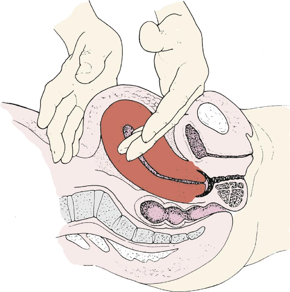 <p>ch. 21 - is key to treating uterine atony, though it may temporarily increase bleeding and expel clots</p>