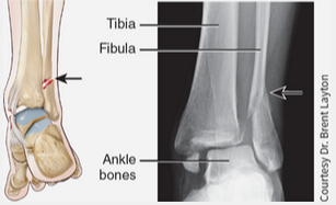 <p>Fracture of the distal end of the fibula (lateral leg bone), with serious injury of the distal tibial articulation.</p>