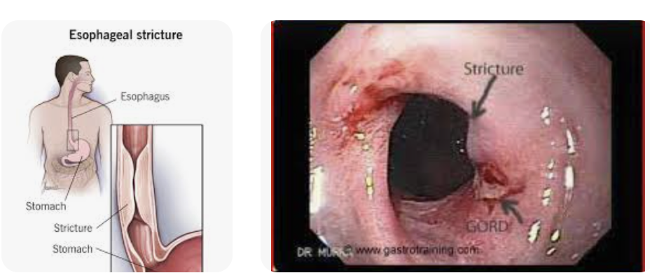<p>Benign strictures</p>