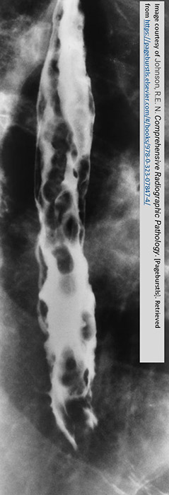 <p>What is an additional modality for diagnosis of esophageal varices?</p>