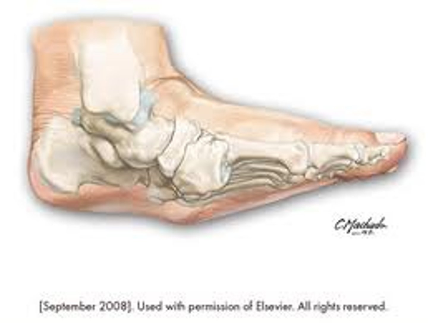 <p>neuropathic fracture/dislocation found in patients with diabetes</p>