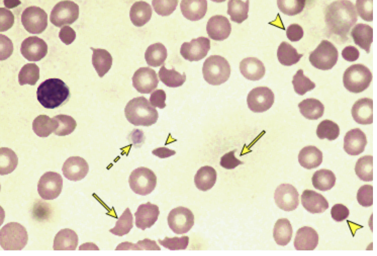 <p>*45 y/o male presents to the ER for HA and fatigue. He also reports some mild SOB. Vitals are stable except for 92% on RA. On physical exam you note the abdomen is tender to palpation, splenomegaly, and widespread petechiae. CBC reveals a low HgB, Hct, and RBCs, Platelets count is 10K, retics are elevated, Coags are normal, <em>LDH and indirect bilirubin are elevated. </em>Peripheral blood smear reveals schistocytes, <em>helmet cells, and triangular cells. </em>ADAMSTS13 activity is under 10%. What is your treatment plan</p>