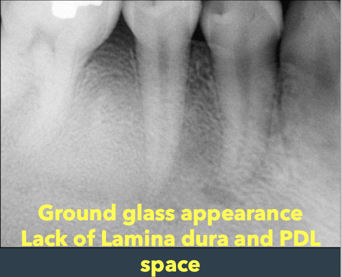 <p>What are some characteristics of fibrous dysplasia on a radiograph?</p>