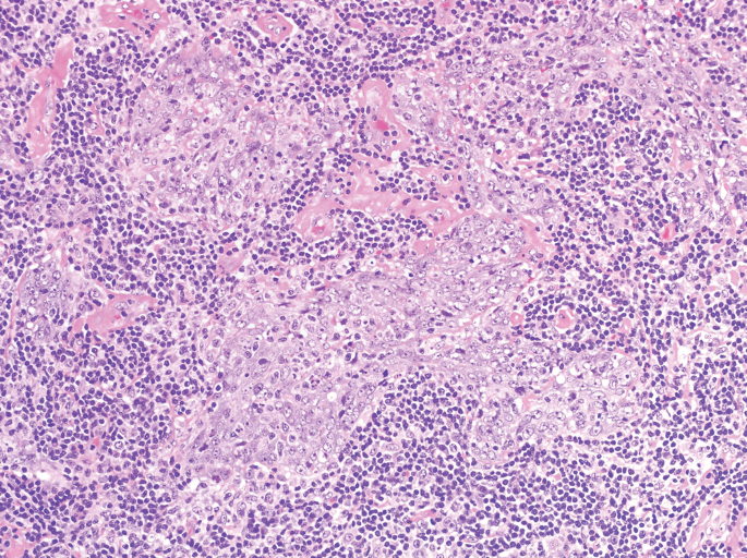 <p>Patient asiatique, tumeur glandes savliaires</p><p>1) Diagnostic</p><p>2) Localisation et population</p><p>3) Histologie</p><p>4) IHC/complément</p><p>5) DD </p>