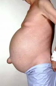 <p>abdominal swelling due to buildup of peritoneal fluid (Associated with liver disease, kidney disease and heart failure)</p>