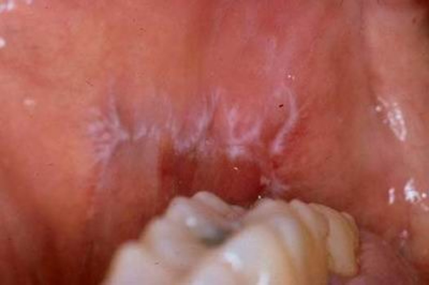 <p>White lacy lines on buccal mucosa - pathognomonic for oral lichen planus</p>