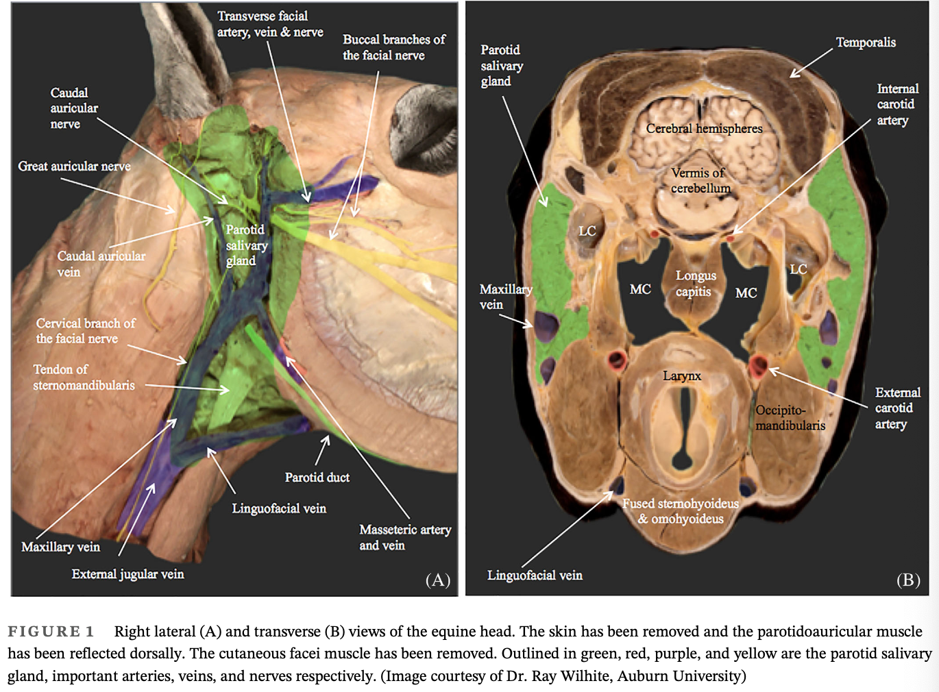 <p>Objectives: To describe the surgical findings, histopathological features, and long-term outcome for a horse with parotid salivary carcinoma</p><p>Results:</p><ul><li><p>Swelling below the base of the right ear</p></li><li><p>Ultrasound examination revealed a mass involving the right parotid salivary gland</p></li><li><p>Incisional biopsy was consistent with parotid carcinoma</p></li><li><p>The tumor was marginally excised along with the lateral wall of the guttural pouch which was reconstructed with a porcine small intestinal submucosal (SIS) sheet</p></li><li><p>Cisplatin beads were implanted in the wound be prior to closure</p></li><li><p>Postoperative complications included right-sided facial nerve paralysis, difficulty with deglutition of fibrous feeds, and surgical site dehiscence</p></li><li><p>Wound healing was achieved by second intention</p></li><li><p>Partial improvement in nerve function was observed within the first 6 months</p></li><li><p>At 12 months post-parotidectomy no sign of tumor reoccurance or metastatic disease was present and the gelding returned to work</p></li></ul>