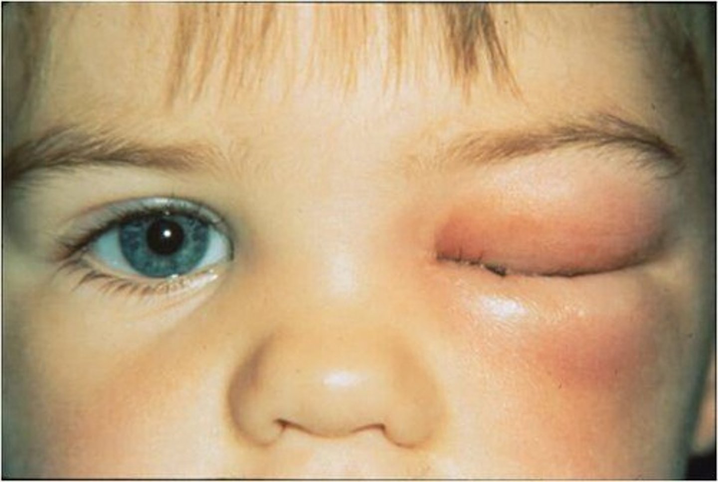 <p>Wat is de lokalisatie van een cellulitis bij kinderen?</p>