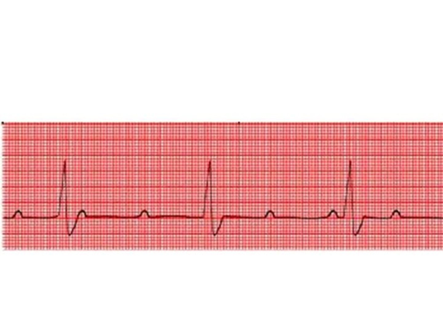 <p>heart block where none of the SA nodal impulses (P-Waves) transmit to the ventricles; no relation between P and QRS waves</p>