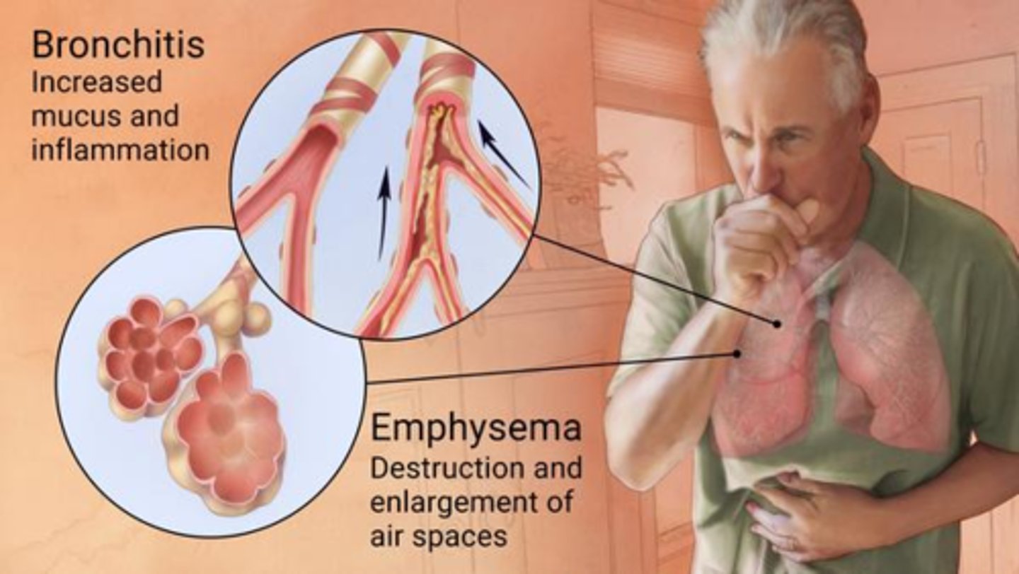 <p>- chronic obstructive pulmonary disease</p><p>- 2 types: emphysema (alveoli enlargement, hyperinflation &amp; inefficient fx) &amp; bronchitis (excess mucous)</p><p>- most COPD: overlapping features, s&amp;s are mixed, tx is the same</p>