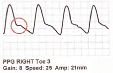 <p>The highlighted area of the following PPG waveform is known as the ______ notch</p>