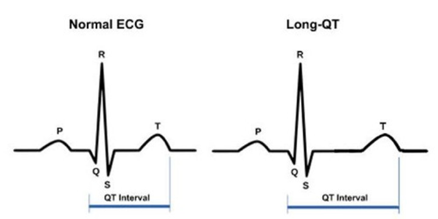 <p>Long QT Syndrome</p>