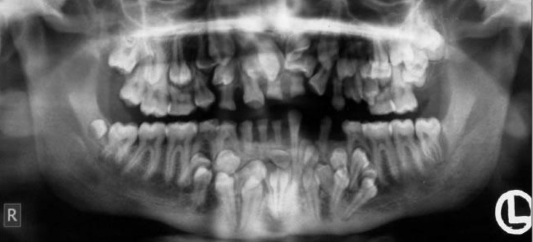 <p>Seen in 20% of patients and cleidocranial dysplasia (more common)</p>
