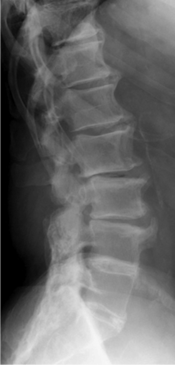 <p>State the radiographic features of diffuse idiopathic skeletal hyperostosis (DISH)</p>