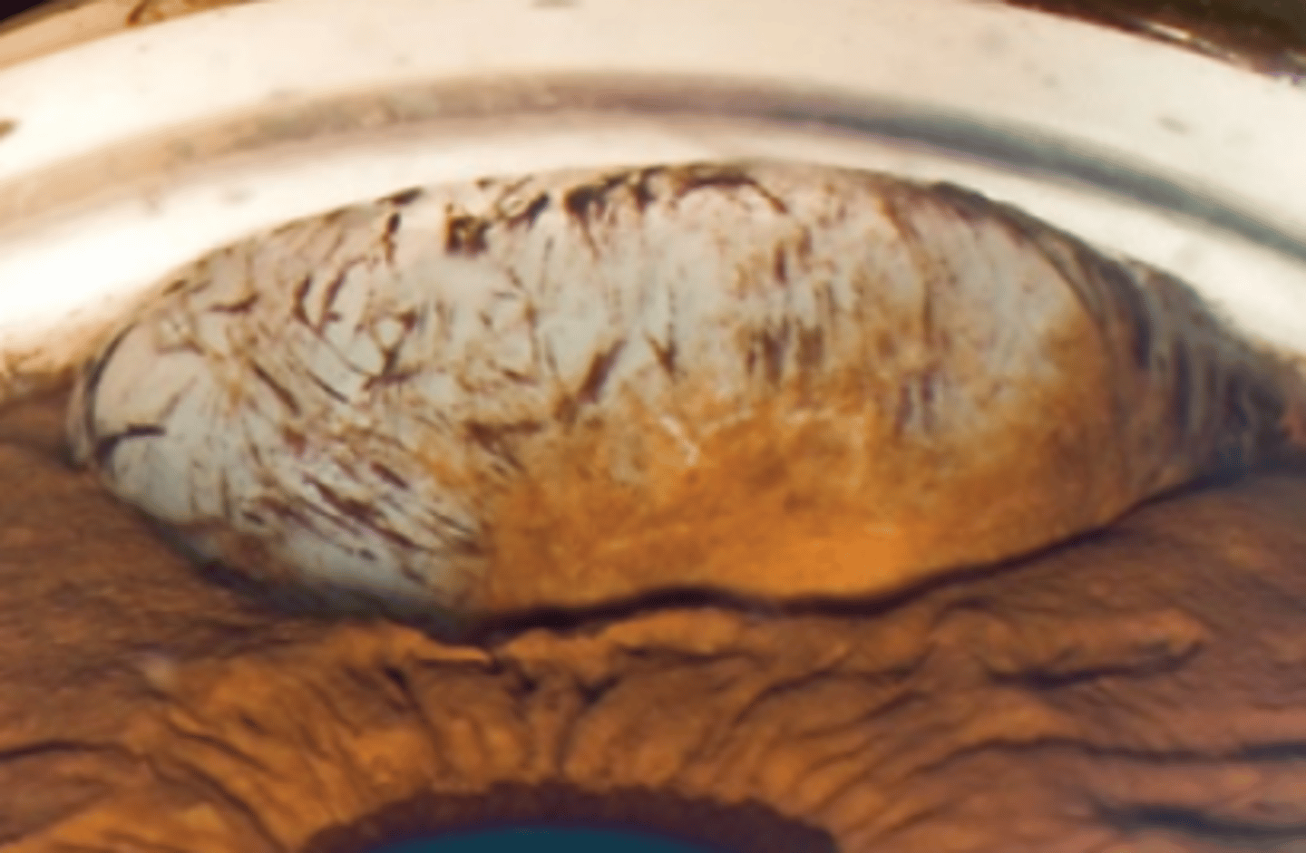 <p>primary iris cyst having a clear anterior wall with a fluid filled lumen. Will transilluminate and usually causes iris deformation. Can be congenital, or acquired. Are not likely to obstruct the angle.</p>