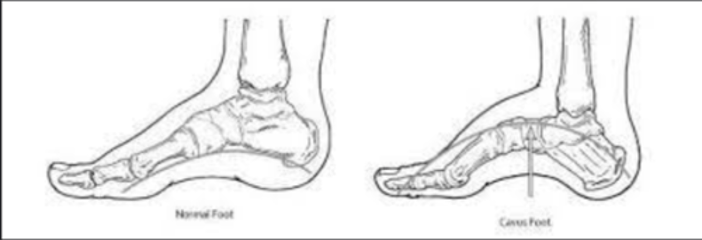 <p>cavovarus foot</p><p>- arch of foot is higher than normal, &amp; heel turns inward</p>