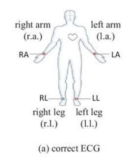 <p><strong>Resting Limb Leads</strong></p><p>-If the patient is at rest, you can place the electrodes on the _______ and ______ <strong>OR </strong>the _____ and ______. These pairs have to remain together. </p>