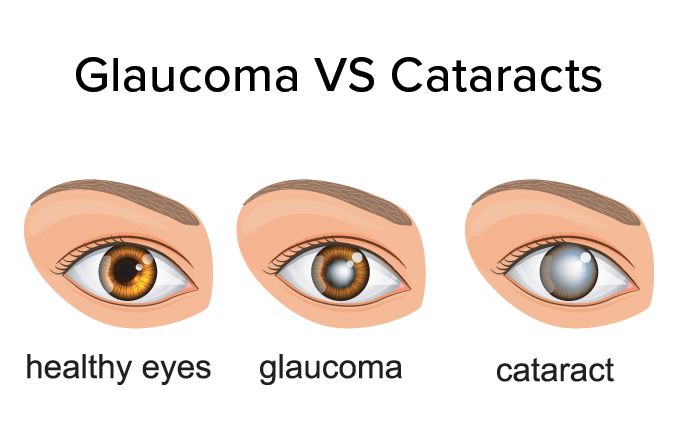 Intraocular structural damage resulting from elevated intraocular pressure. Obstruction of the outflow of aqueous humor causes this. Without treatment the disorder leads to blindness. 