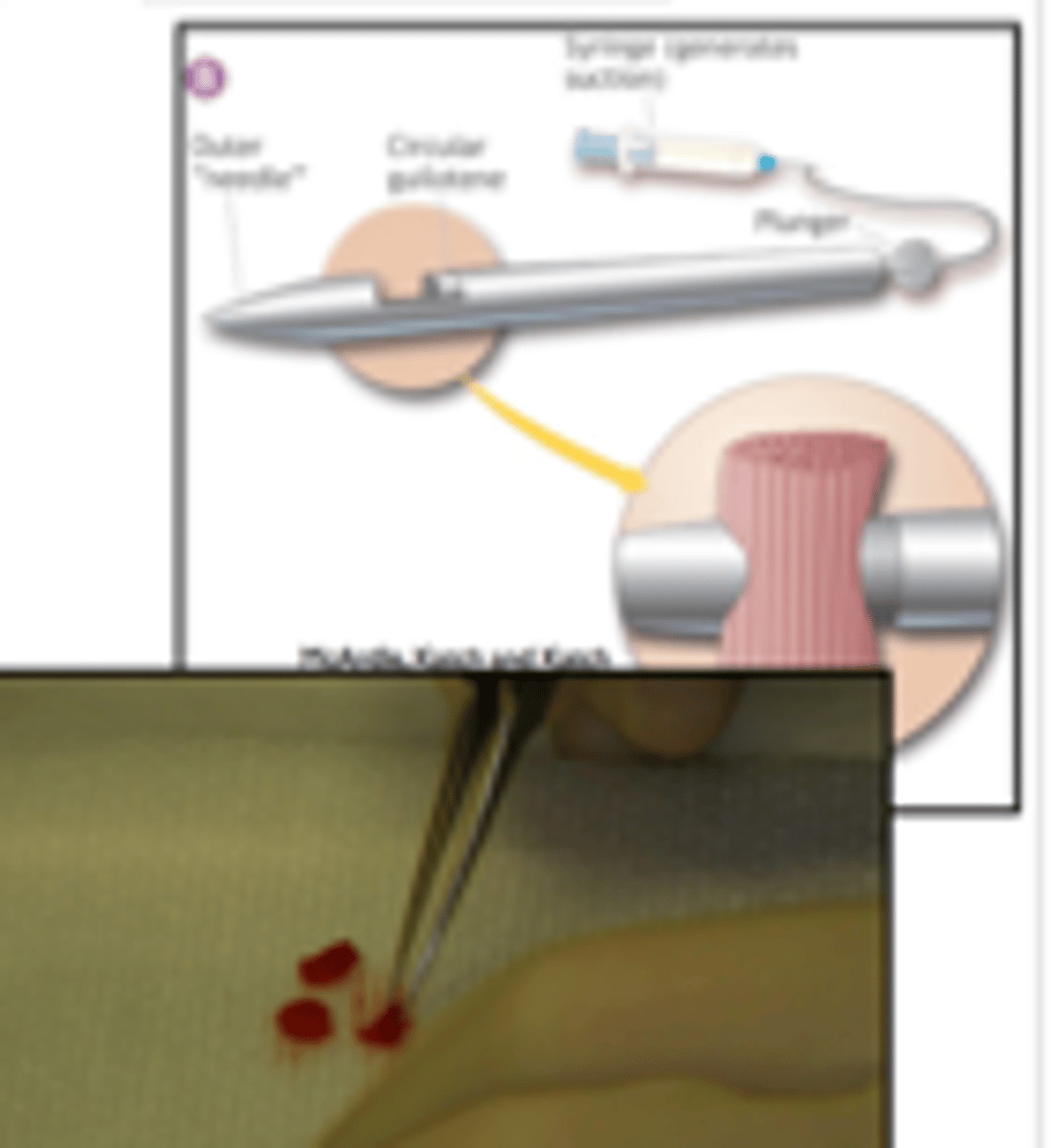 <p>involves removal of a plug of tissue for examination. A biopsy needle is commonly used to obtain this specimen.</p>
