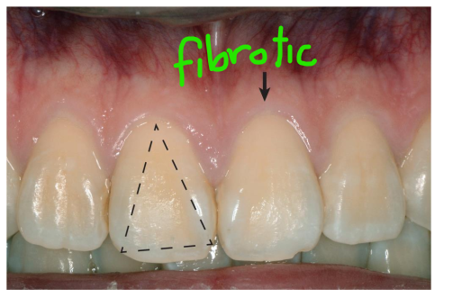 <ol><li><p>Slender, triangular-shaped crown</p></li><li><p>Thick, fibrotic gingiva</p></li><li><p>Narrow to moderate zone of keratinized tissue</p></li><li><p>Accentuated scalloped gingival margin contour</p></li></ol><p><em>**prone to development of mucogingival deformity </em></p><p></p>