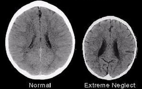 * Children are affected MENTALLY TOO by no socialization
* Neglect **MINIMIZES** a child’s brain
* **LOVE IS A NECESSITY**
* **EX:** Genie looked like a 7-year-old even though she was 13-years old. The left part of her brain was not stimulated, she never heard people speak, she was a teenager and could never learn