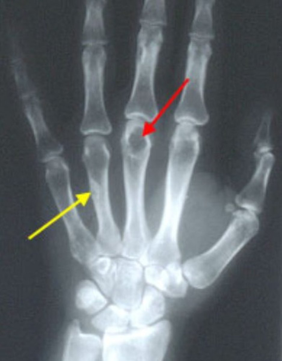 <p>areas of demineralization; bone cysts</p>
