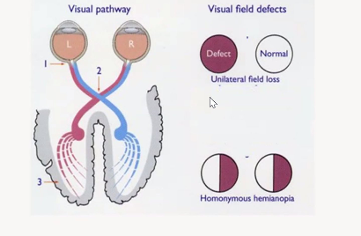 <p>The loss of the right or left half of the field of vision in both eyes. Due to leision at the optic tract/visual cortex of the brain (as left hemisphere of brain controls visual hemfield for right of both eyes and visa versa)</p>