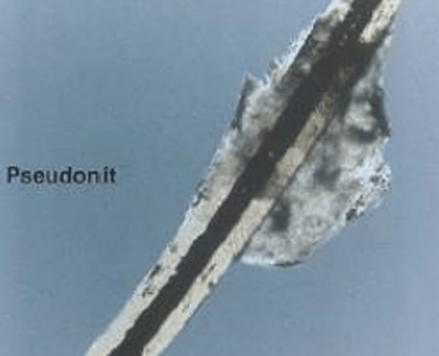 <p>Nit: </p><p>- Egg of Phthiriasis Pubis</p><p>- Cemented 1-2mm from lash base</p><p>- Cap with air holes</p><p>- Mimics blepharitis debris</p><p>Pseudonit: </p><p>- Blepharitis debris</p><p>- Makeup debris</p><p>- Hair casts</p><p>- Pseudonits will move when manipulated! (vs. a nit will be cemented and not move)</p>