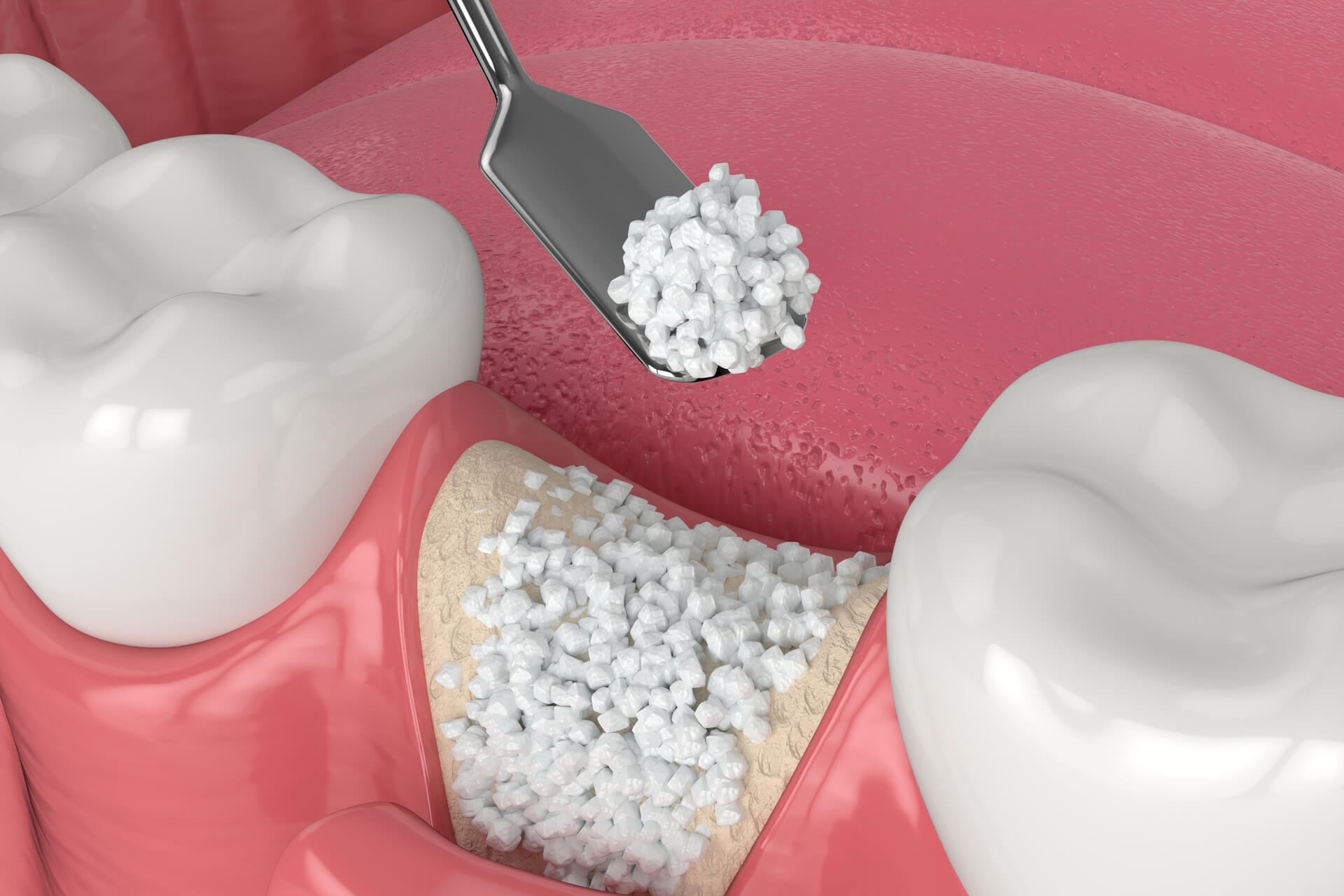 <p>Bone graft</p>