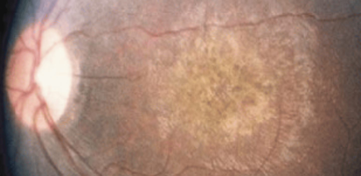 <p>a group of autosomal recessive inherited retinal dystrophies which is the most common genetic cause of visual impairment in children. Better prognosis if it is the RPE65 gene involved due to the fact that there is gene therapy available. Appears as diffuse white spots of the retina, vessel attenuation, optic nerve edema and pallor. Also presents as nyctalopia, nystagmus, and oculodigital syndrome.</p>