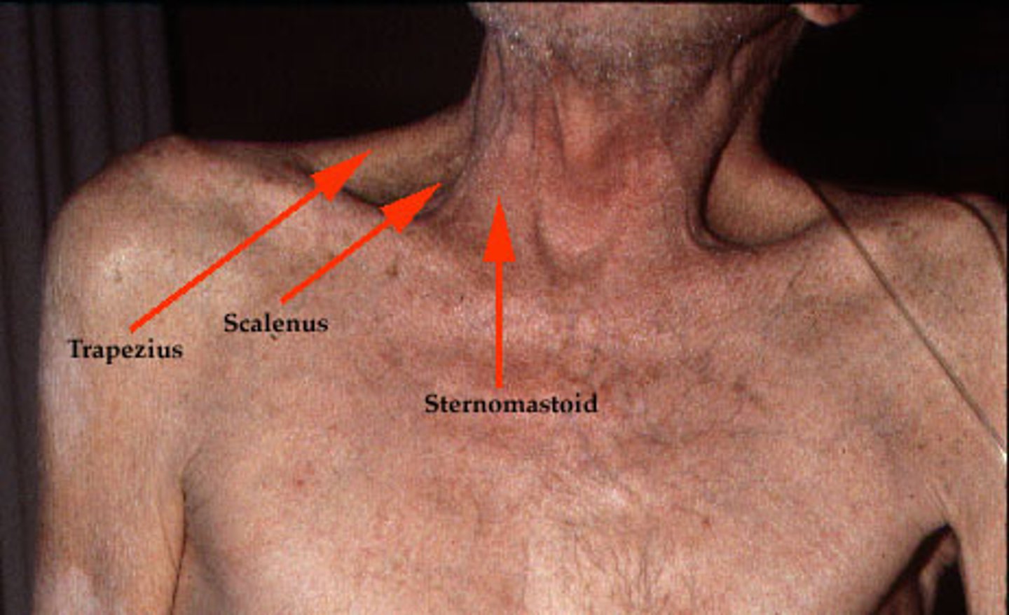 <p>-Sternocleidomastoids</p><p>-Scalenes</p><p>-Abdominal muscles</p>