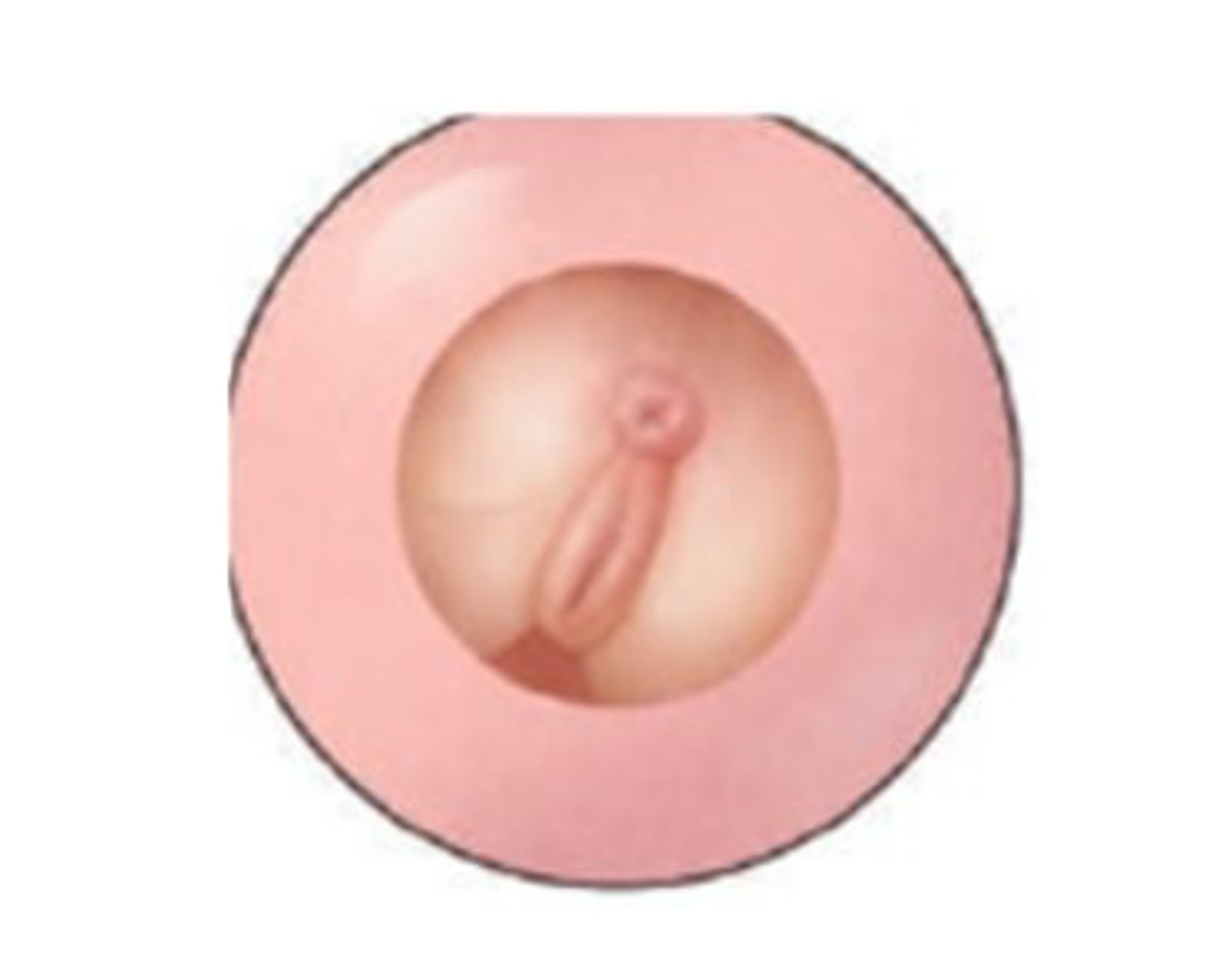 <p>38) During an intrapartum vaginal examination the following is palpated. In which type of presentation is this fetus?</p><p>A) Breech</p><p>B) Shoulder</p><p>C) Occiput face</p><p>D) Occiput brow</p>