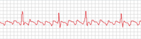 <p>what is an atrial flutter?</p>